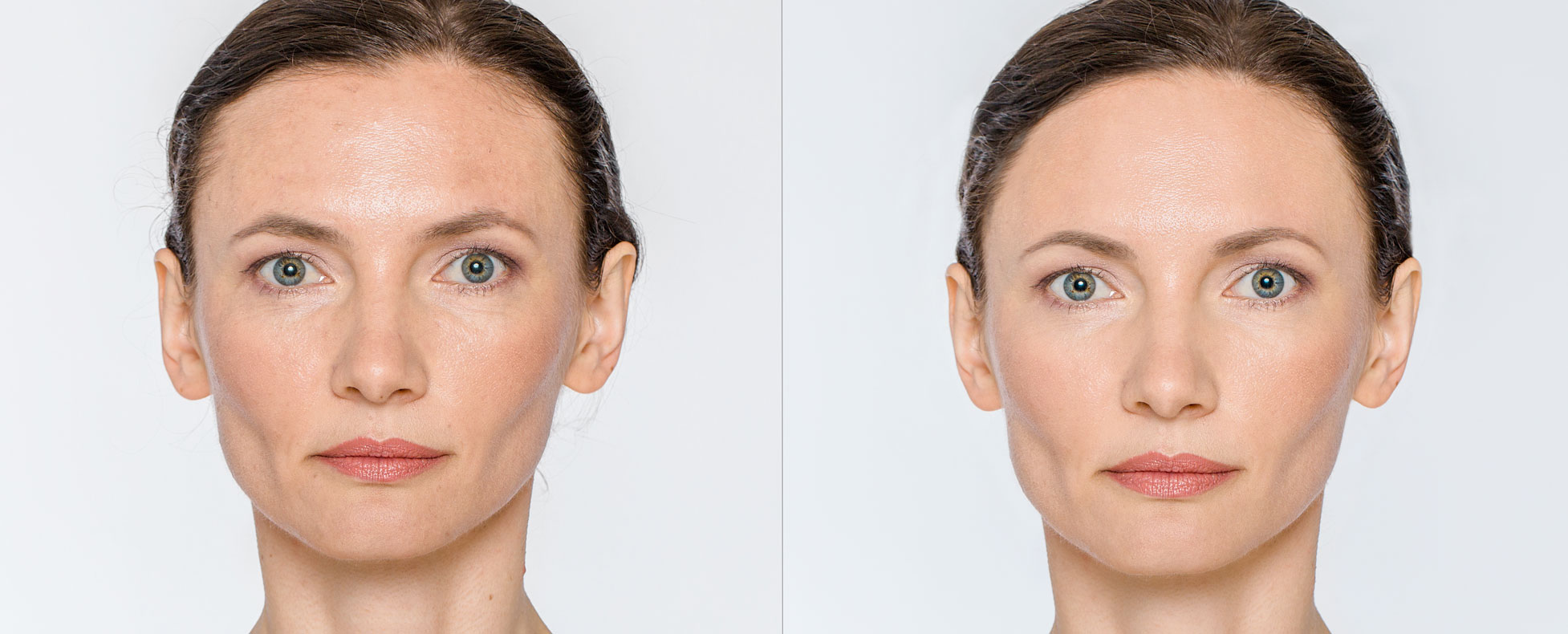 injection PRP visage